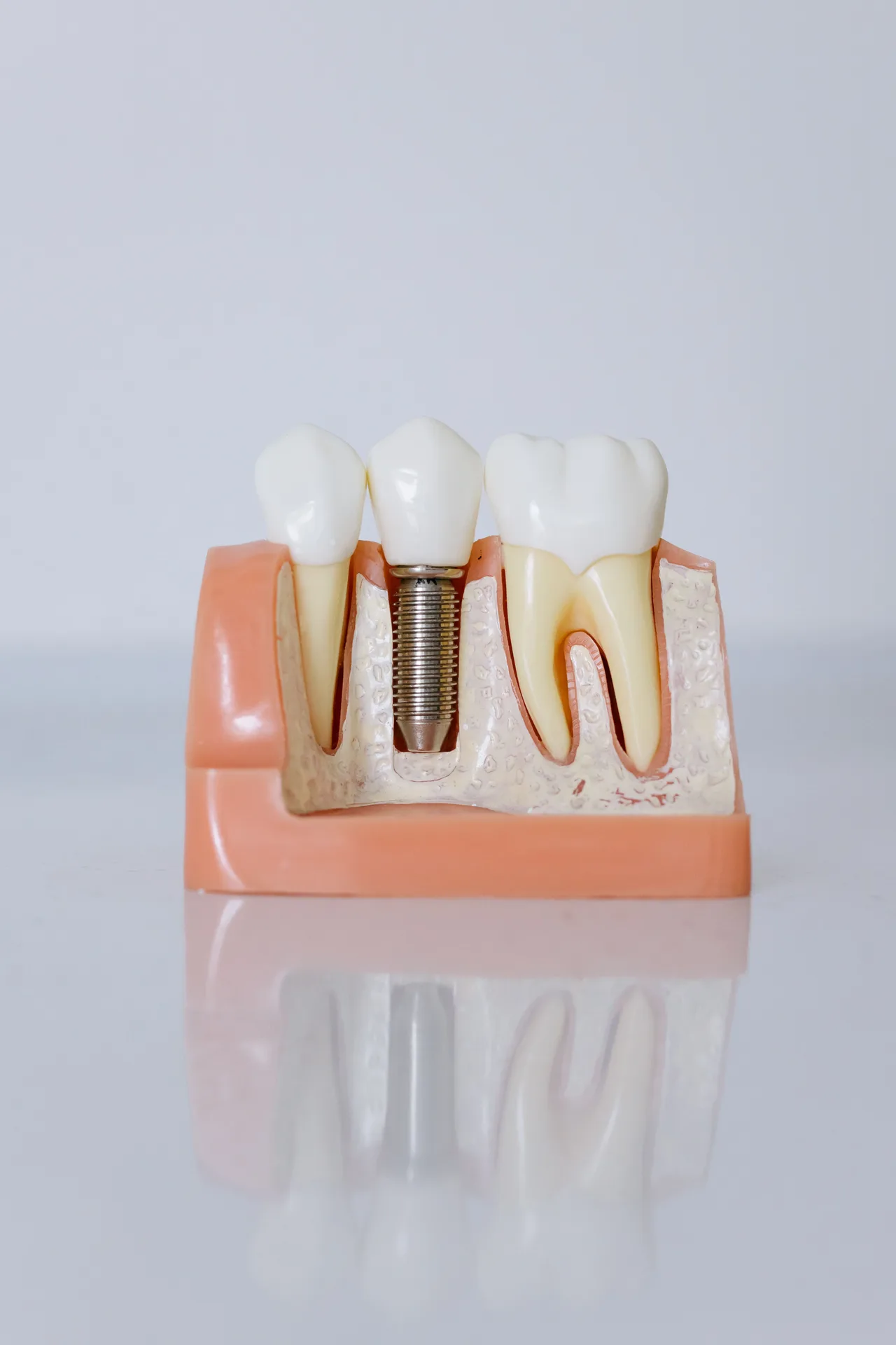 Dental restoration model for root canal care at Plaza Dental Arts