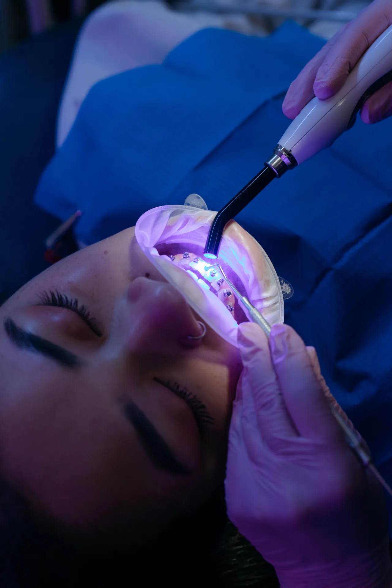Patient receiving professional teeth whitening at Plaza Dental Arts